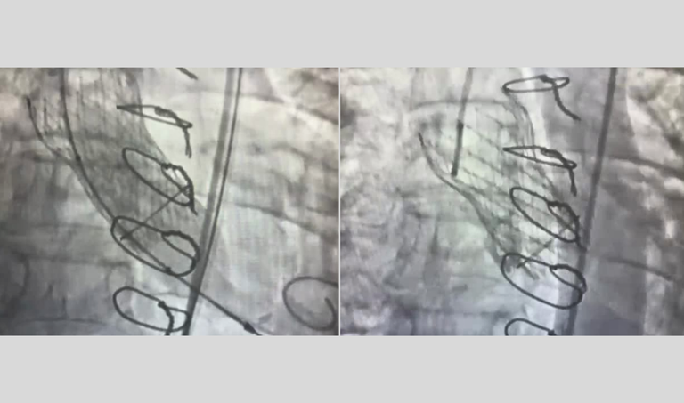 20260317 implante de válvula aórtica imagem 1 - imagens-do-procedimento-video.png
