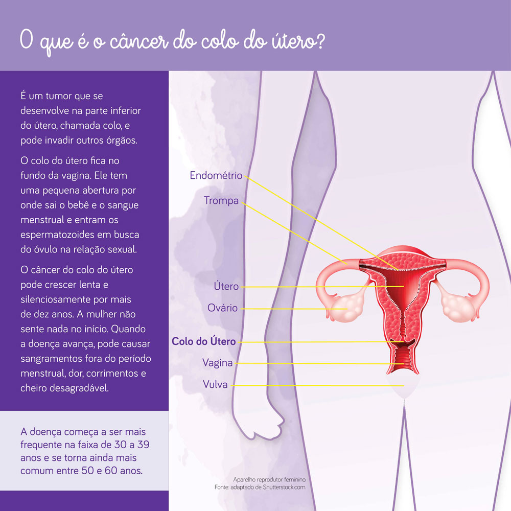 É um tumor que se desenvolve na parte inferior do útero, chamado colo. Pode ser um câncer silencioso, sem muitos sintomas durante seu crescimento.