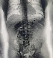 PRF prende foragido que supostamente engoliu drogas em Linhares/ES