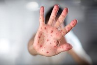 Nota técnica traz novas orientações sobre doença de mão-pé-boca