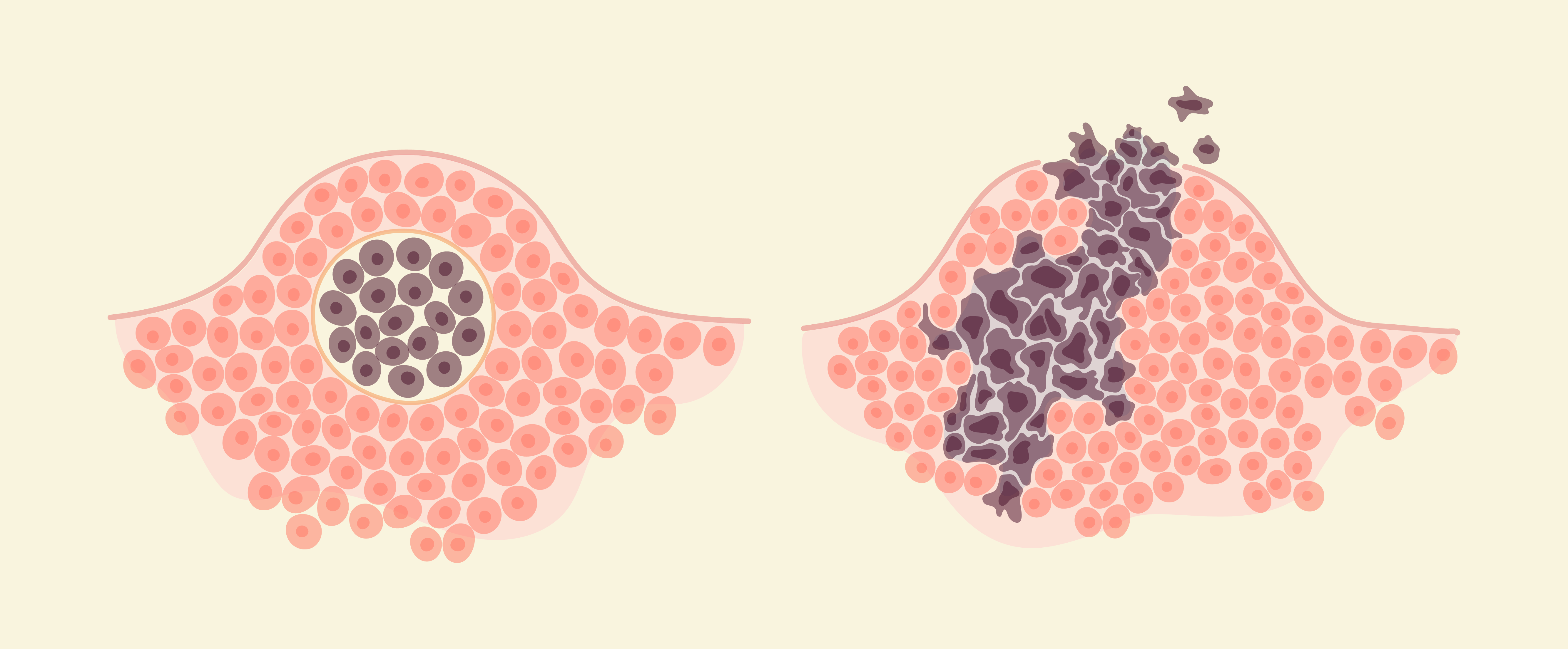 Por que um câncer se espalha?