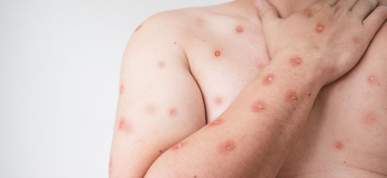 mpox_feridas.jpg