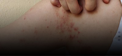 Janeiro Roxo: tudo o que você precisa saber sobre hanseníase