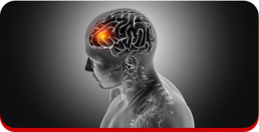 Ilustração de um cérebro humano com uma região destacada em laranja, indicando possível área afetada por um AVC (Acidente Vascular Cerebral).