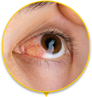 Pessoa com Conjuntivite