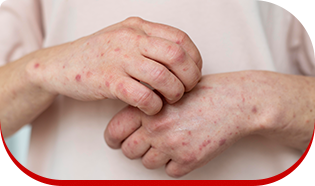 Pessoa com sarampo apresenta erupções avermelhadas na pele e coceira intensa nas mãos.