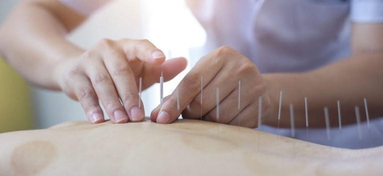 Lei da Acupuntura garante mais segurança aos pacientes